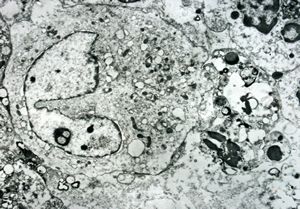 eosinophilic granuloma - Langerhans cell